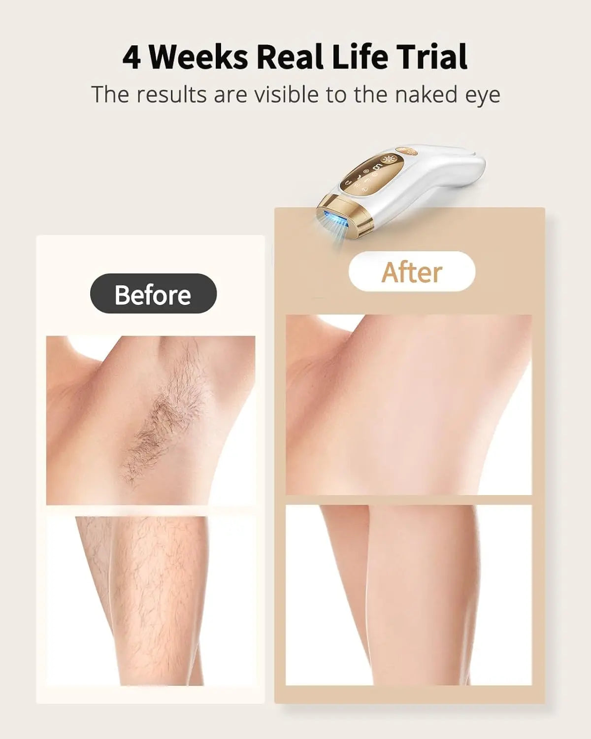 Laser Hair Removal